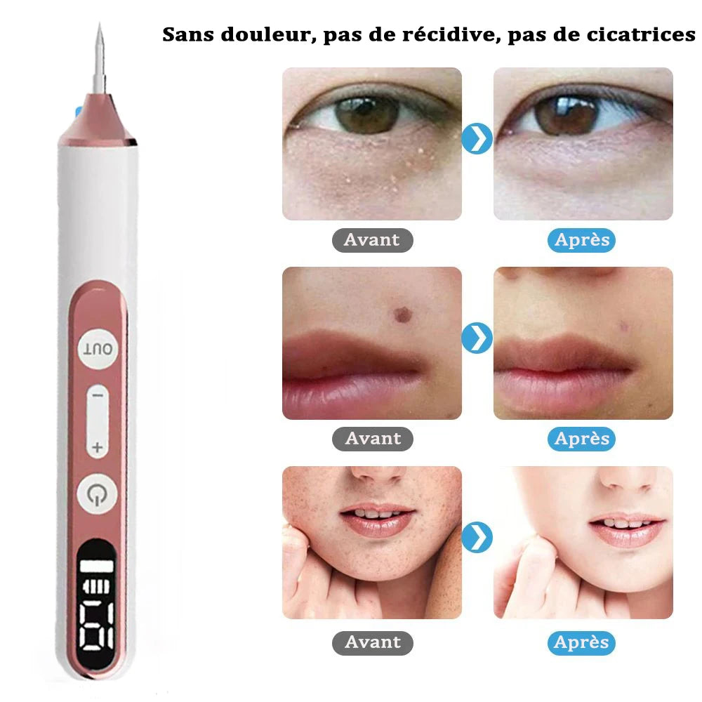 Stylo Électrique d'Élimination des Verrues et Acrochordons – Stylo Laser Plasma pour Éliminer Verrues, Papillomes, Taches Sombres, Grains de Beauté et Acrochordons