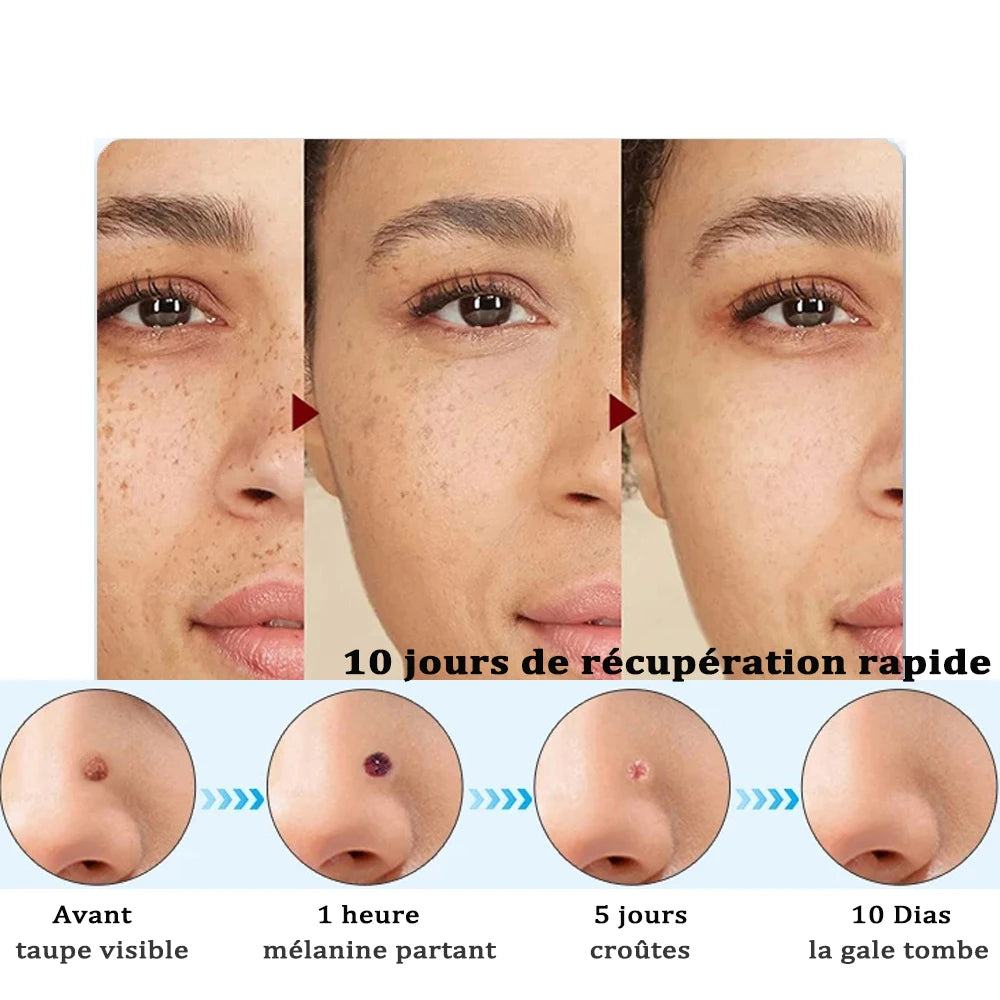 Stylo Électrique d'Élimination des Verrues et Acrochordons – Stylo Laser Plasma pour Éliminer Verrues, Papillomes, Taches Sombres, Grains de Beauté et Acrochordons